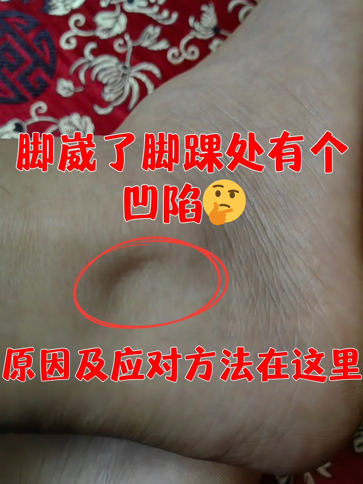 脚崴了怎么办?