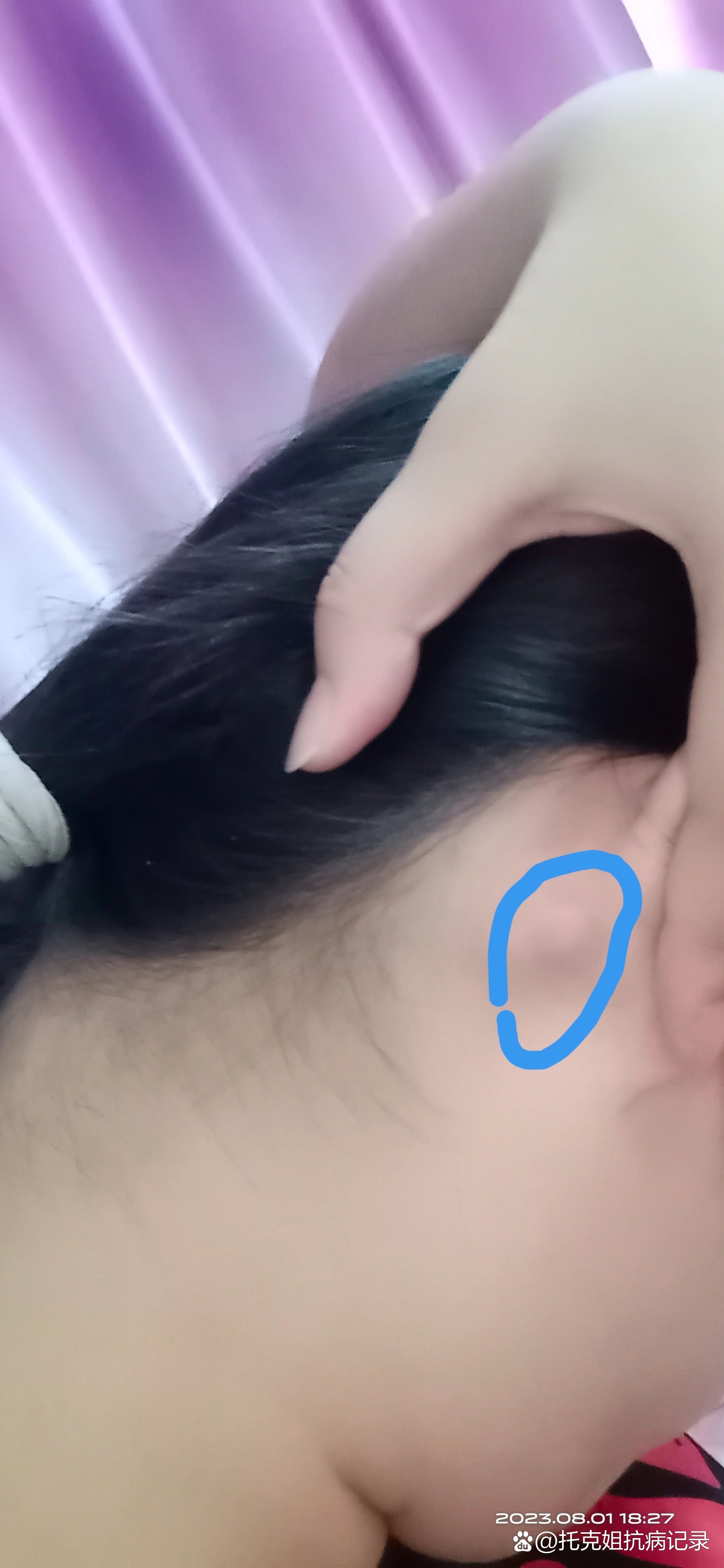 打耳洞后,耳垂后面长了个硬块怎么办