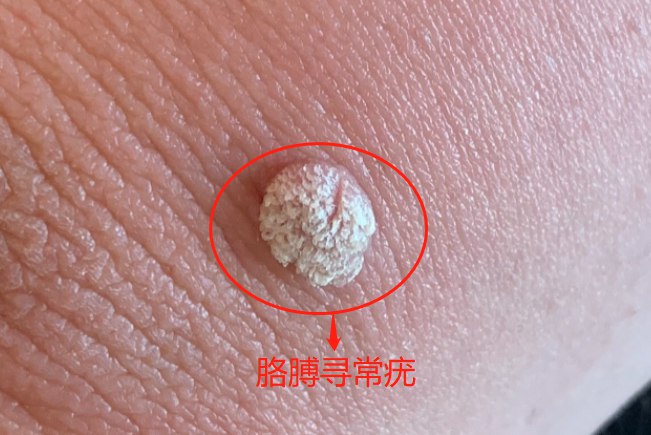 寻常疣会传染给别人吗