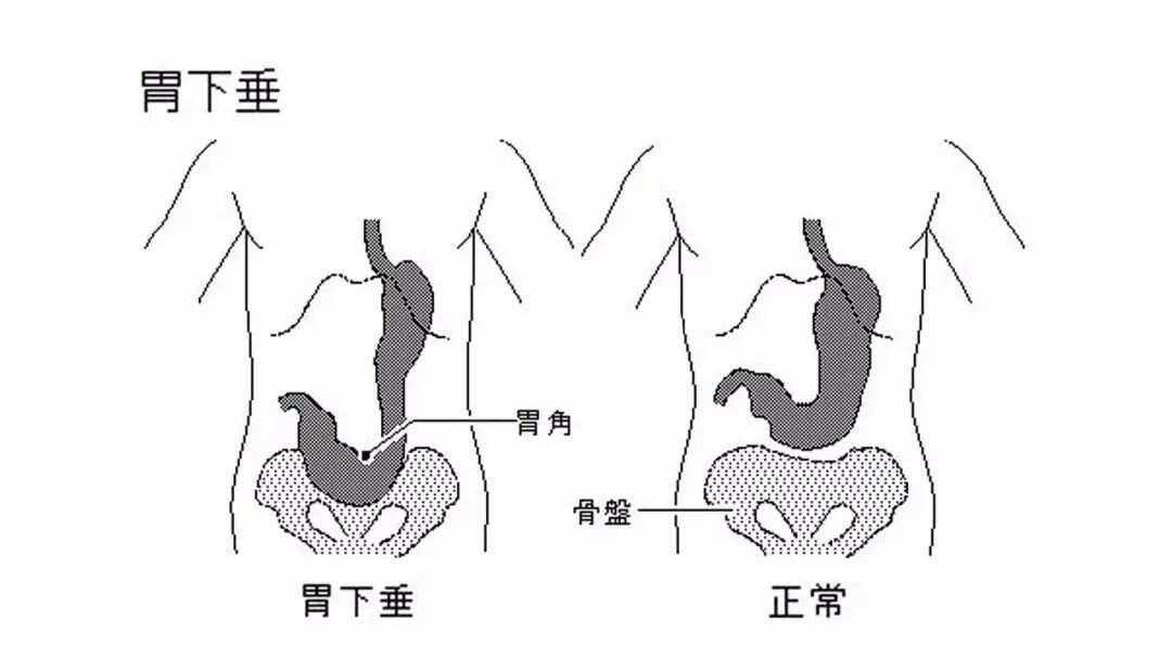 胃下垂有哪些症状