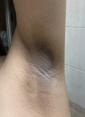 腋下有味道