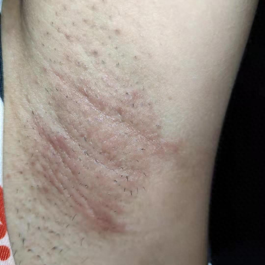 腋下有味道