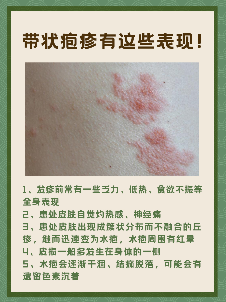 长蛇胆疮怎么办