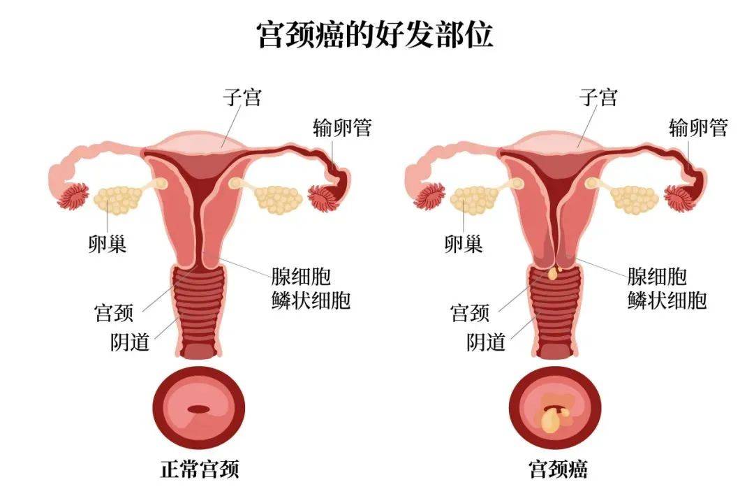 输卵管癌症