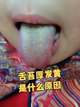 舌苔发黄是怎么回事