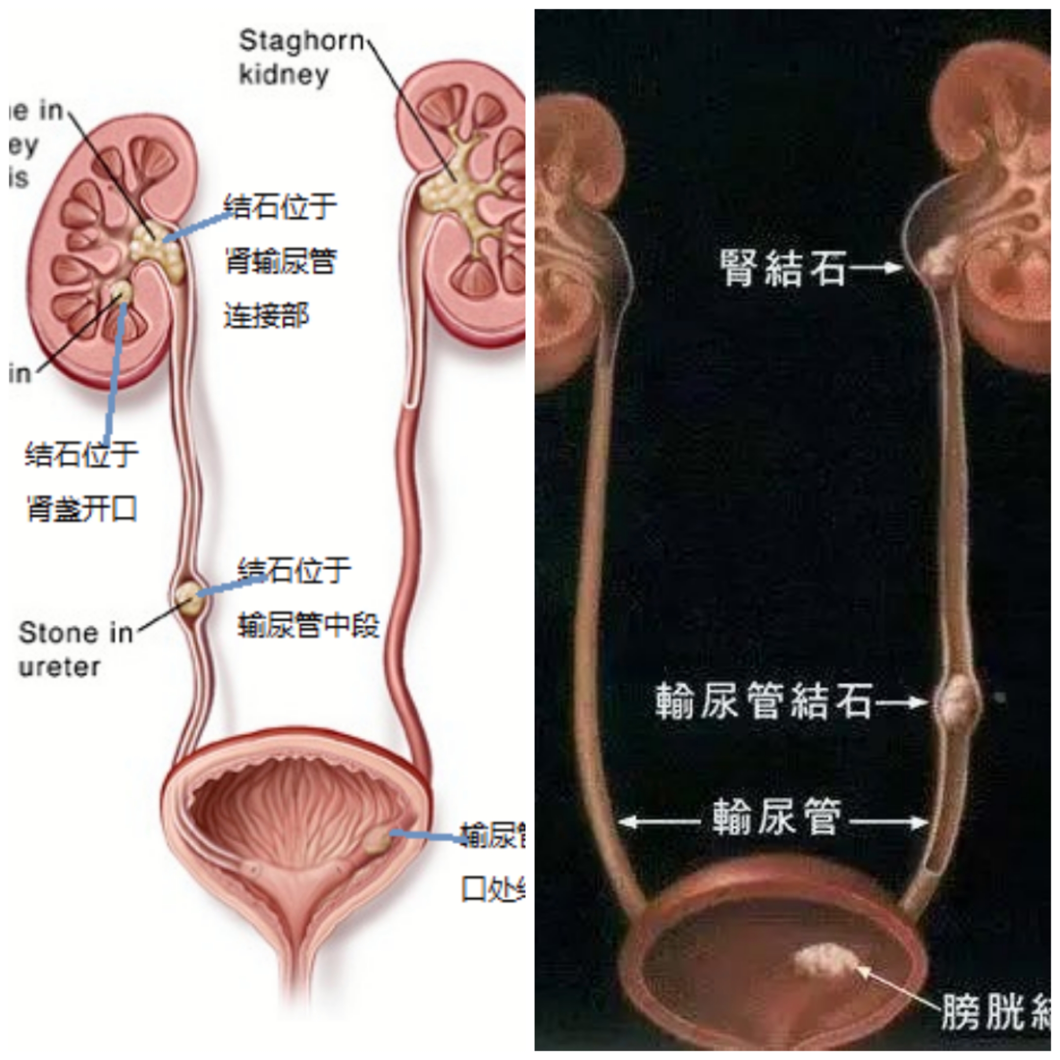 膀胱结石怎样排出体外