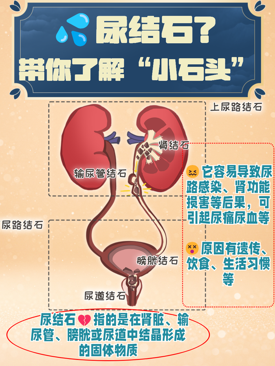 膀胱结石怎样排出体外