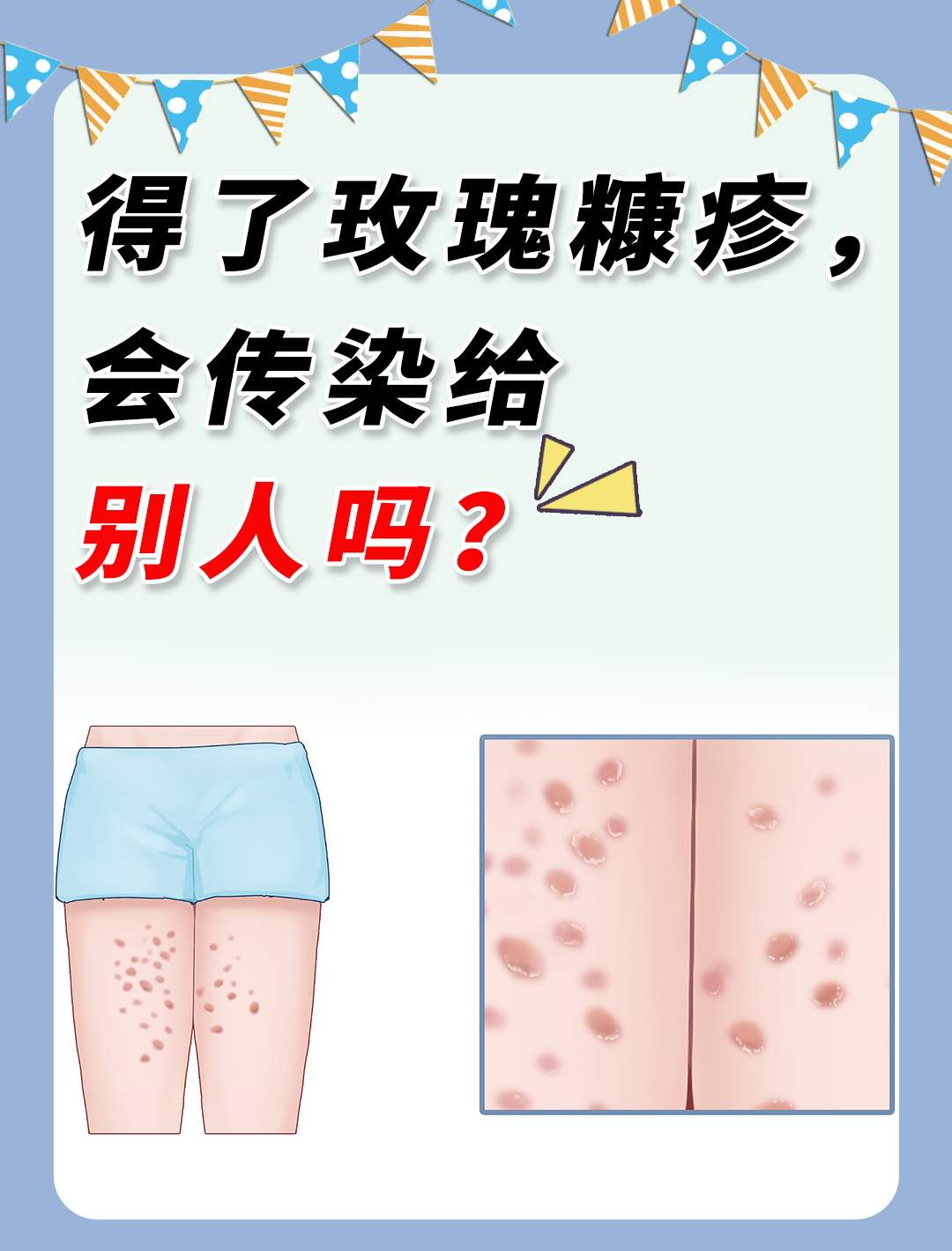 玫瑰糠疹快好了的前兆有哪些