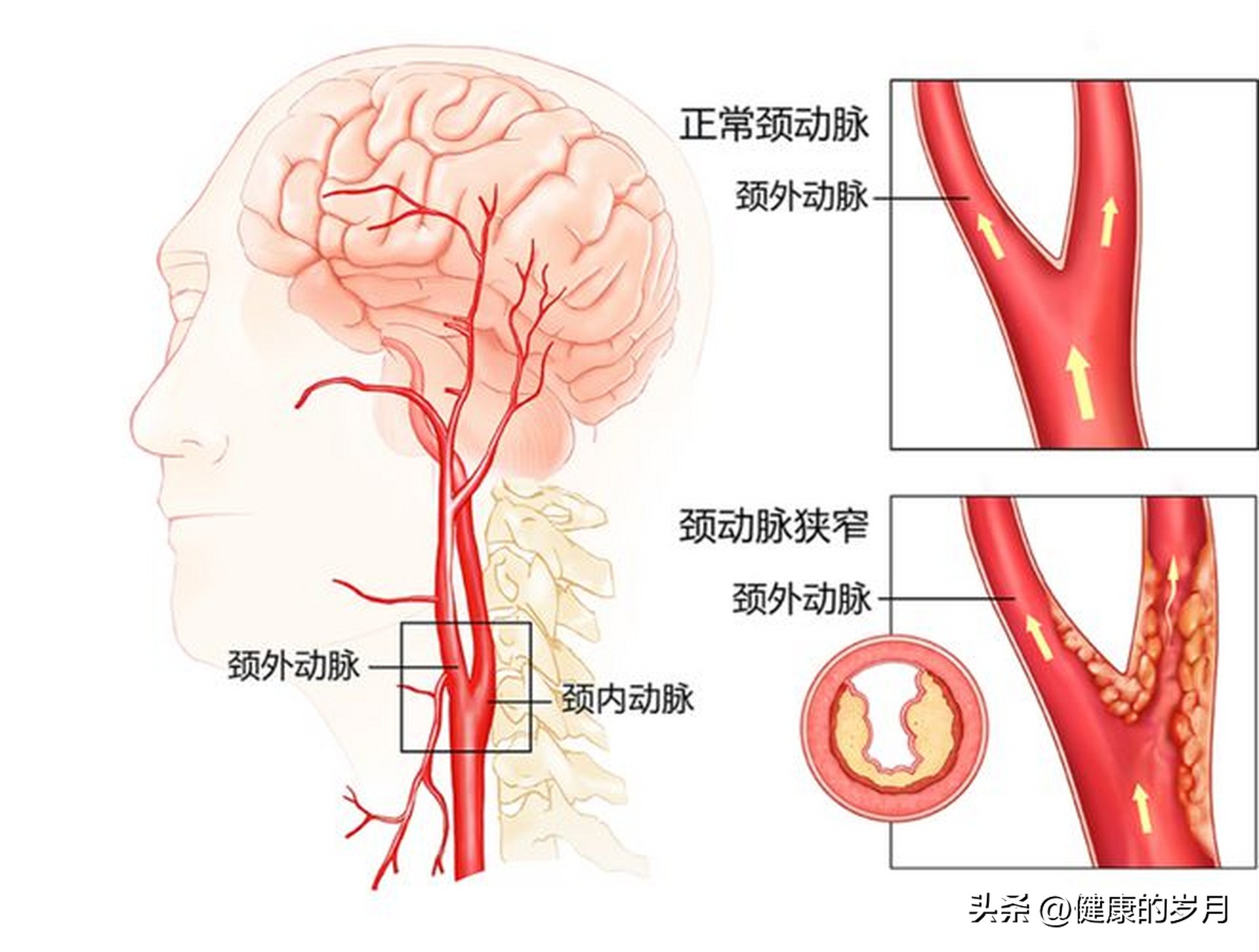 颈动脉斑块如何治疗