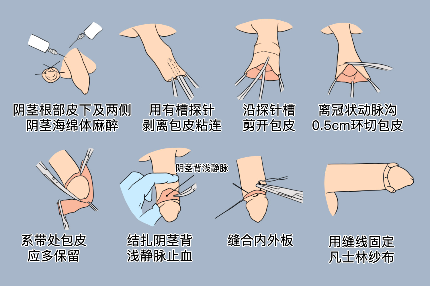 割完包皮多长时间能好