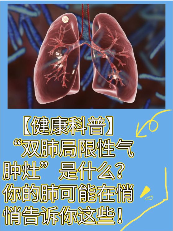 双肺多发纤维灶是什么意思?