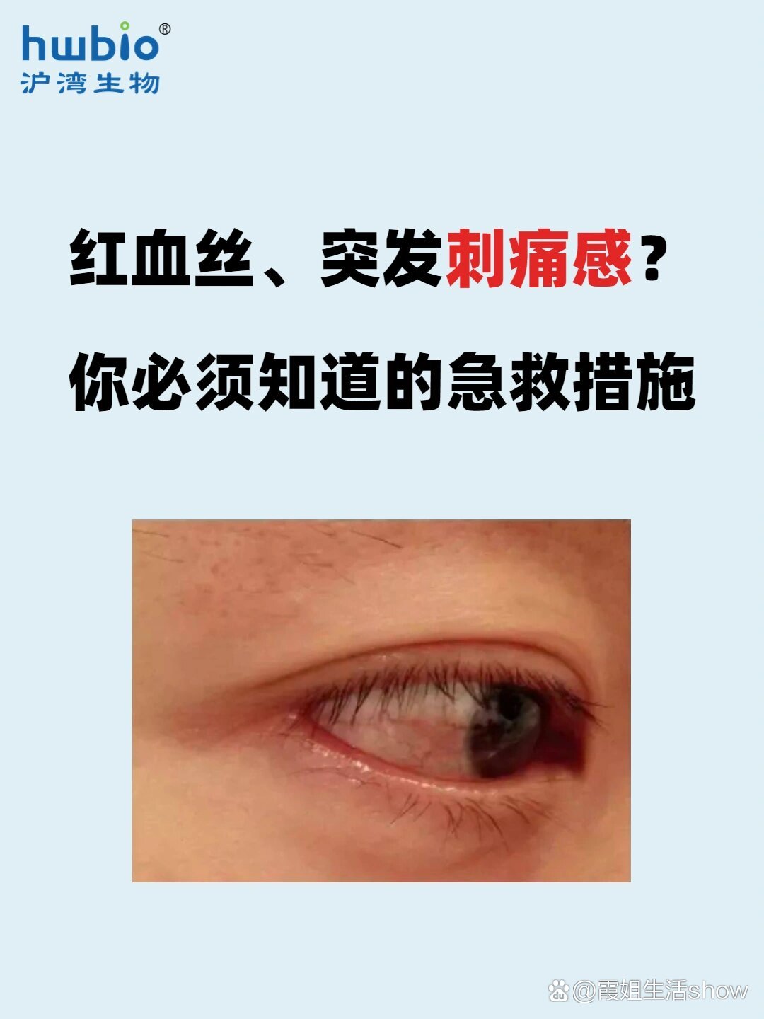 眼睛里有很多红血丝怎么办