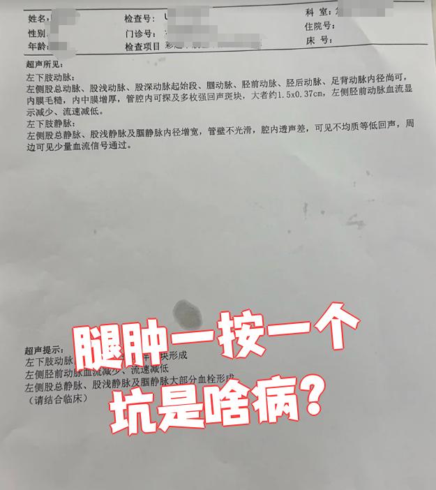 小腿浮肿,一按一个坑怎么回事?
