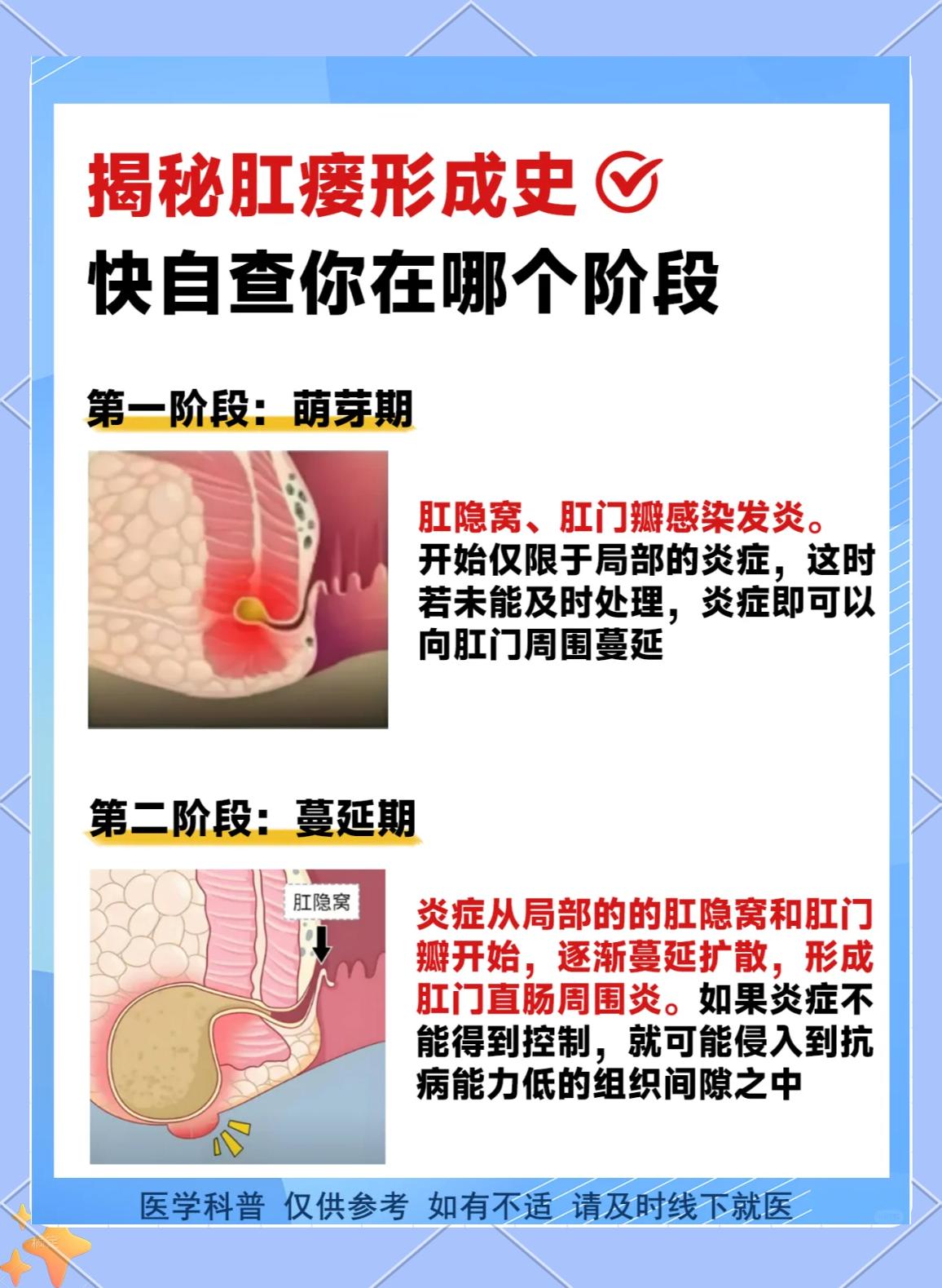 肛瘘手术多久可以同房