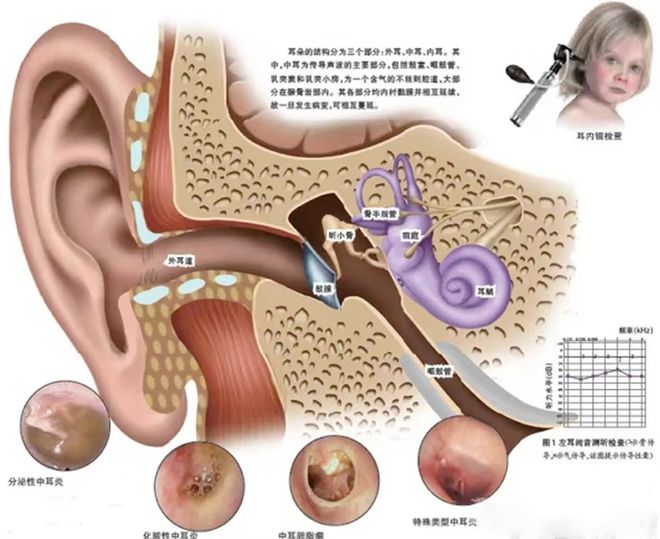 中耳乳突炎有哪些症状?