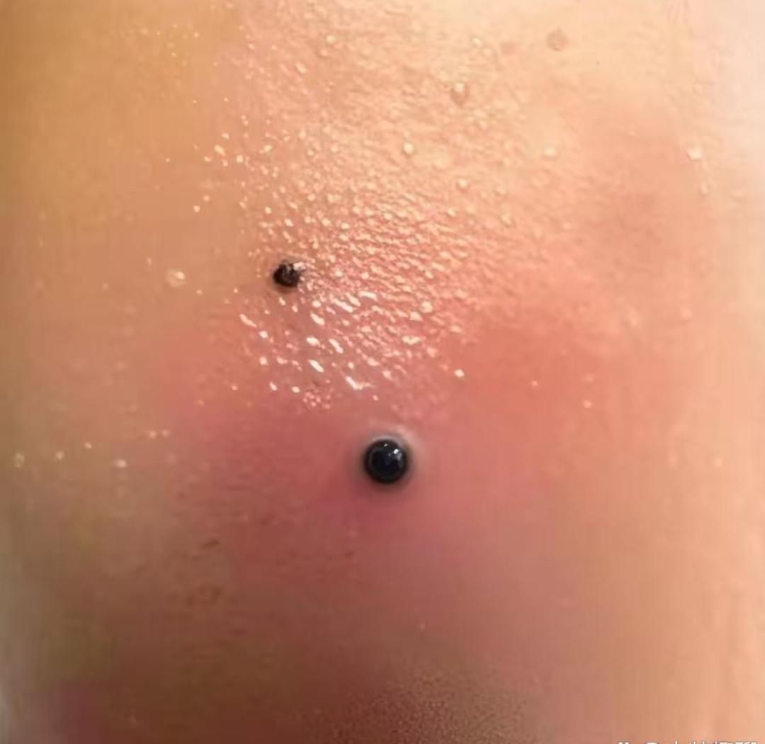 屁股上长了个疙瘩怎么办