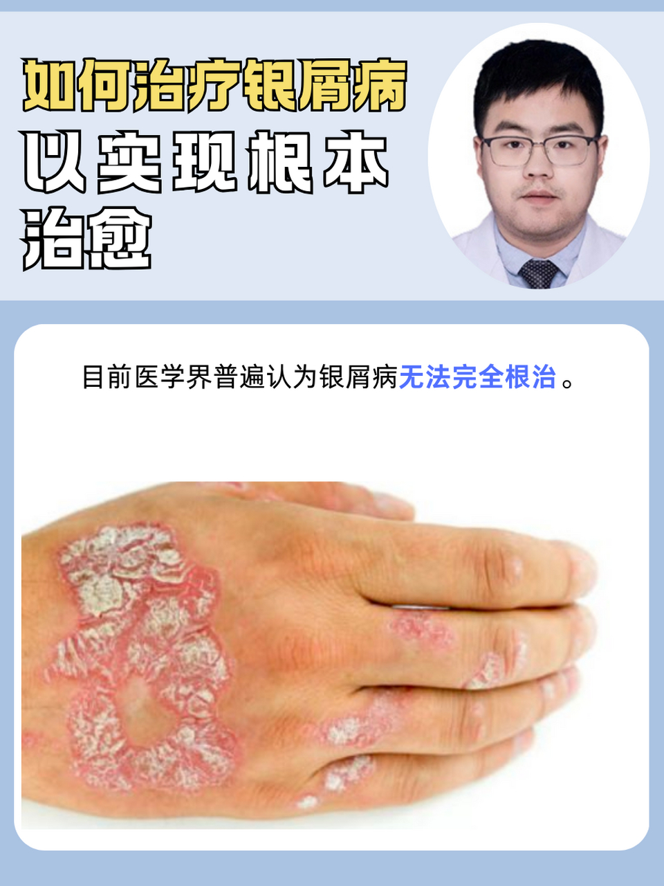 银屑病可以治愈吗?
