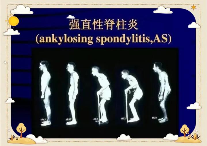 强直性脊柱炎有哪些症状表现?