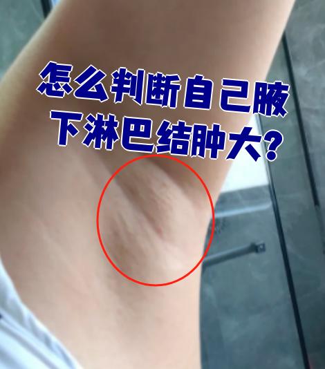 淋巴结发炎肿大,严重吗