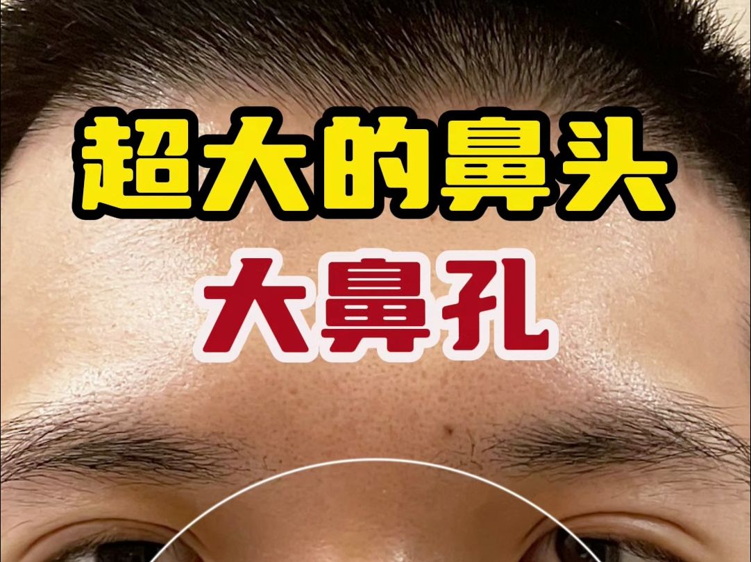 鼻孔很大怎么办