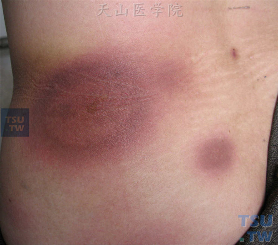 药疹的临床表现?