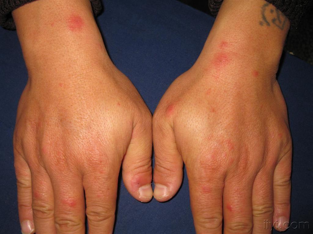 药疹的临床表现?