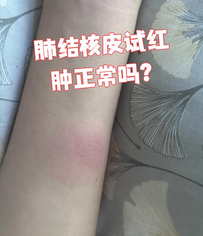 肺结核皮试