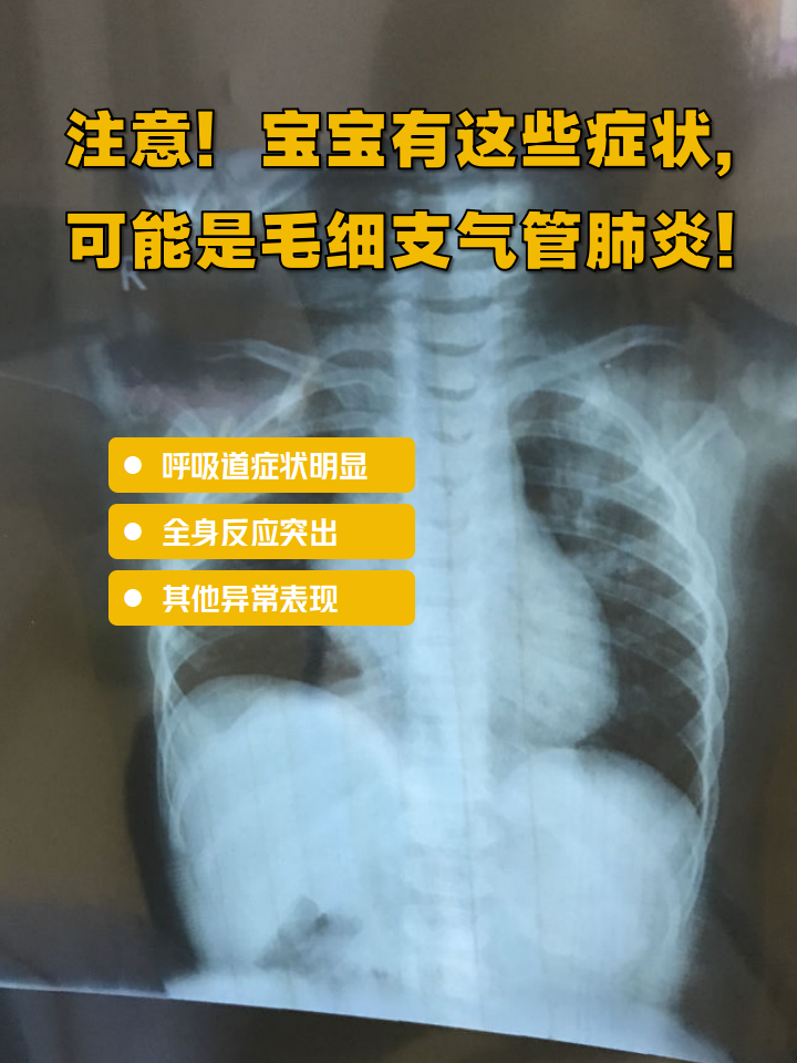 小儿肺炎症状有哪些