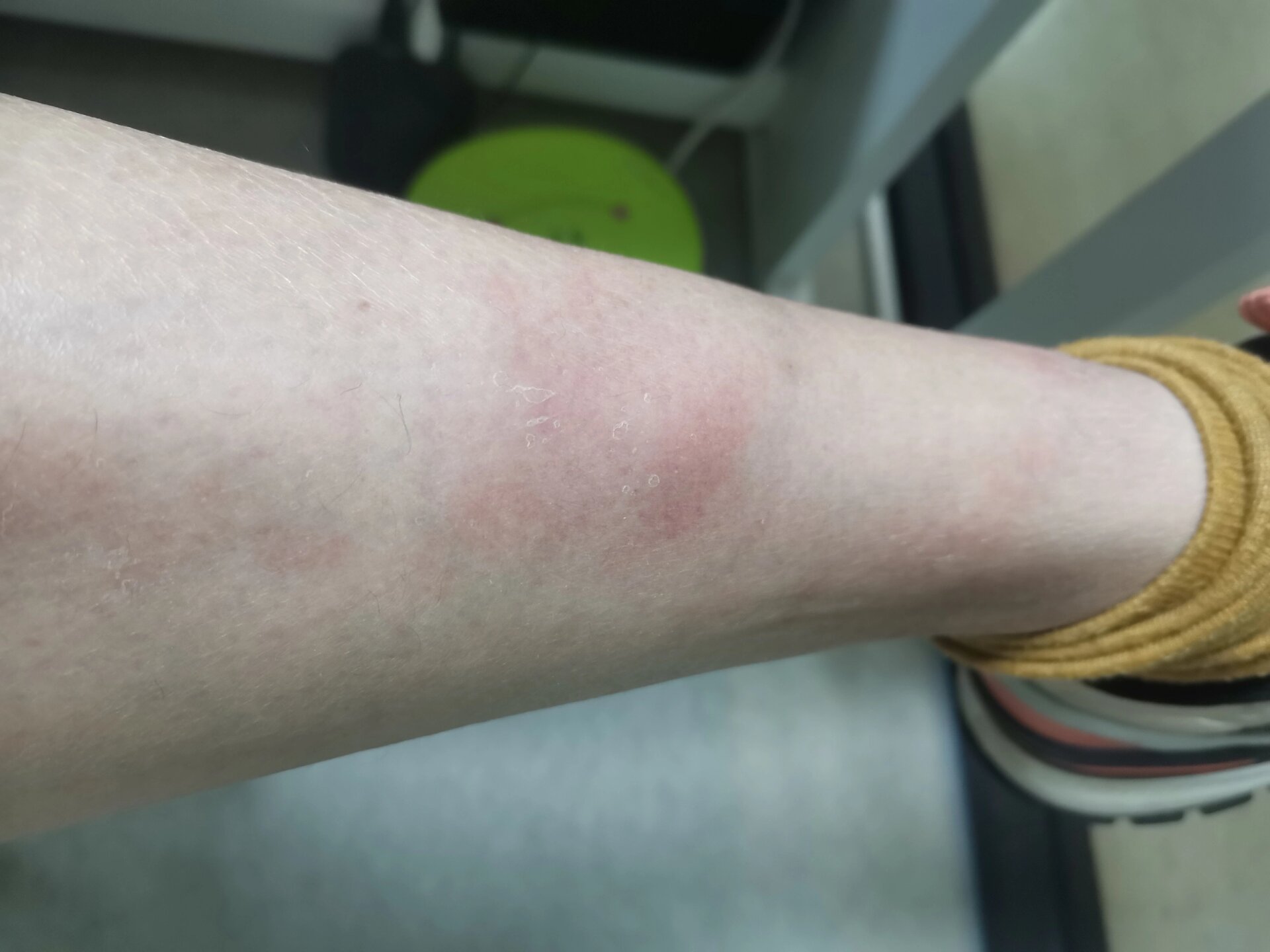 腿上有红斑