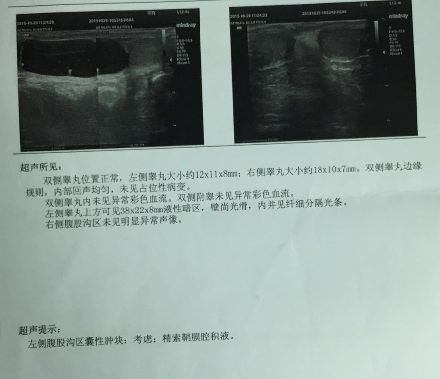睾丸一个大一个小怎么回事