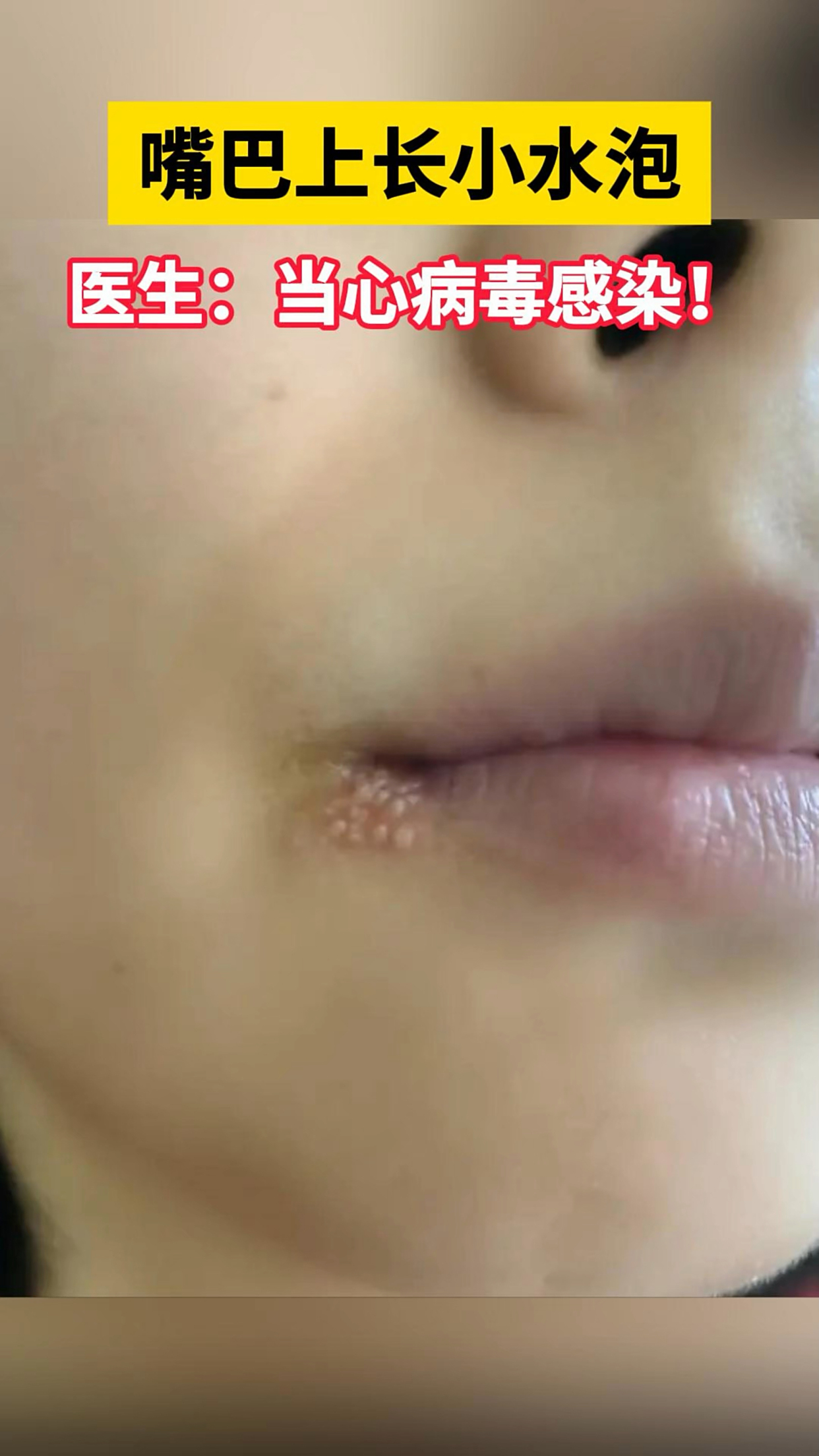 上嘴唇长了很多小水泡吃什么好