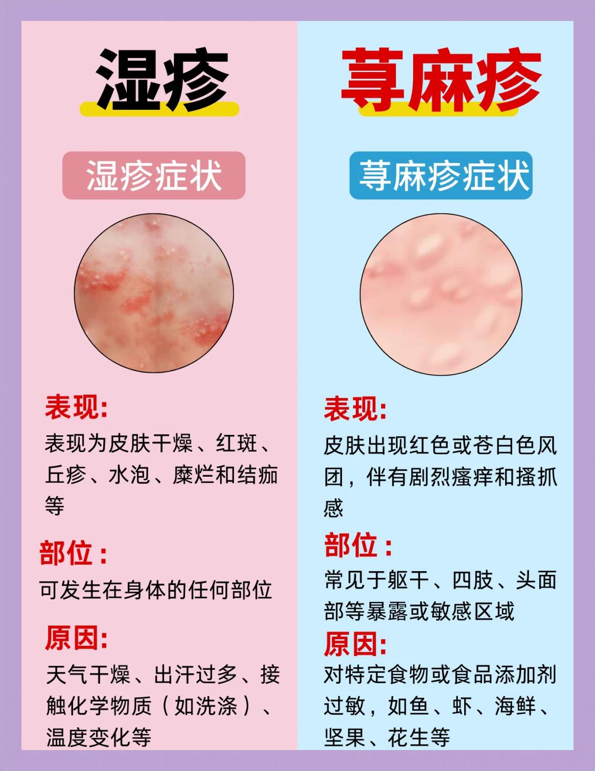 丘疹性荨麻疹有哪些小方法止痒