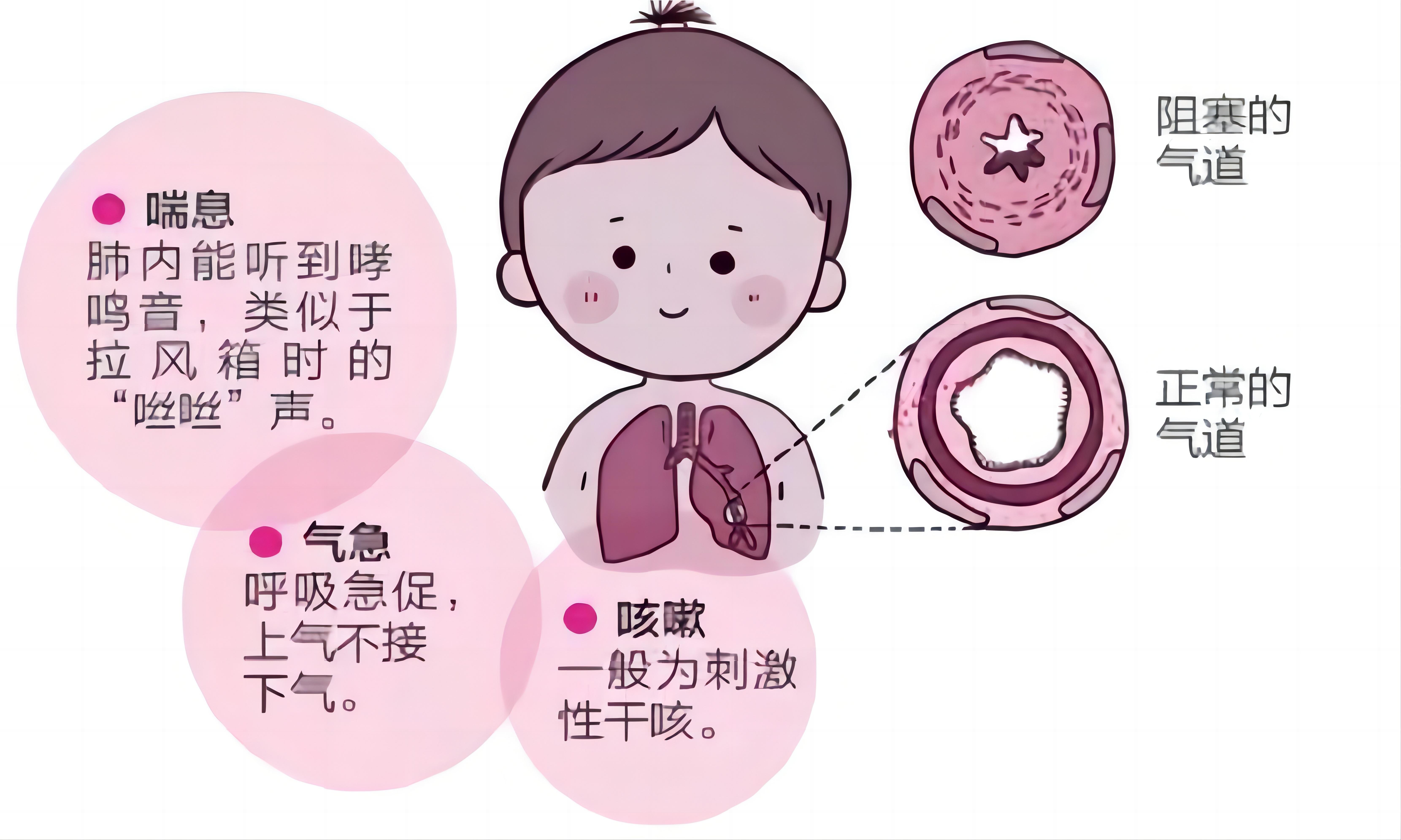 儿童哮喘的症状有哪些