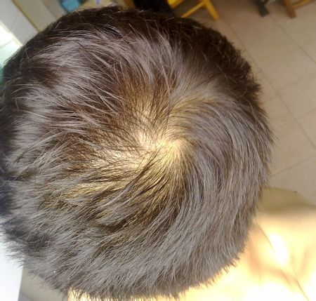 肾虚导致的脱发能恢复吗