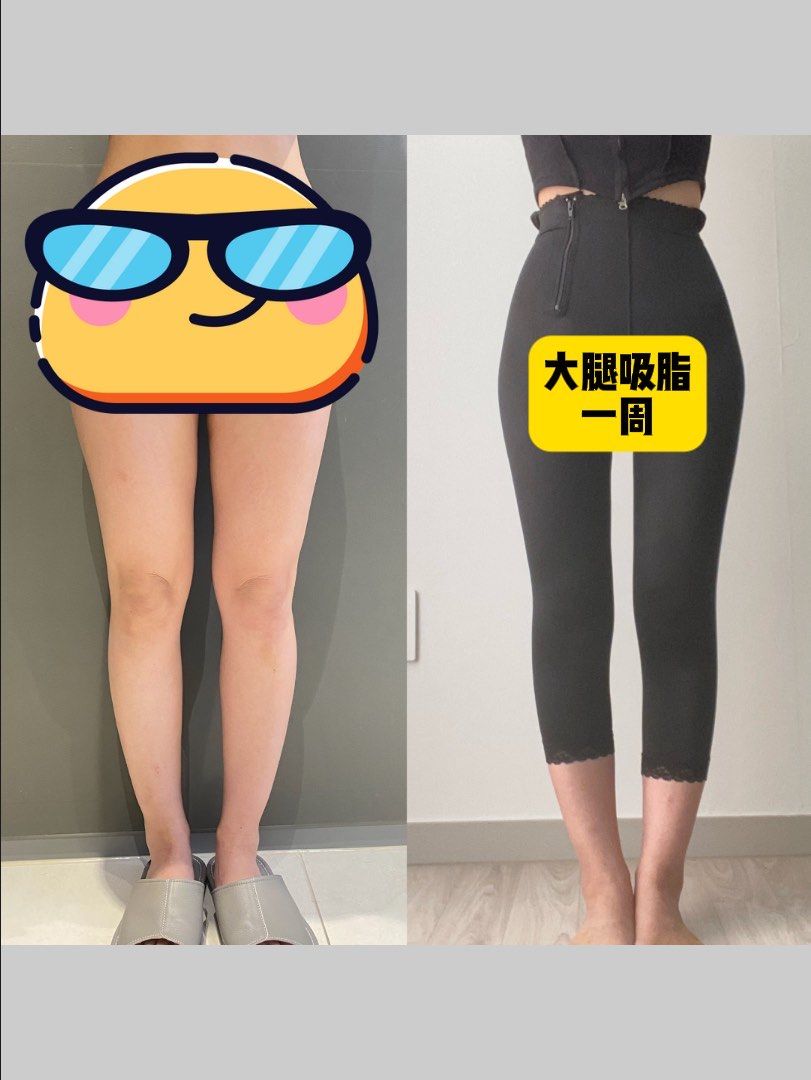 腿部抽脂要多久康复