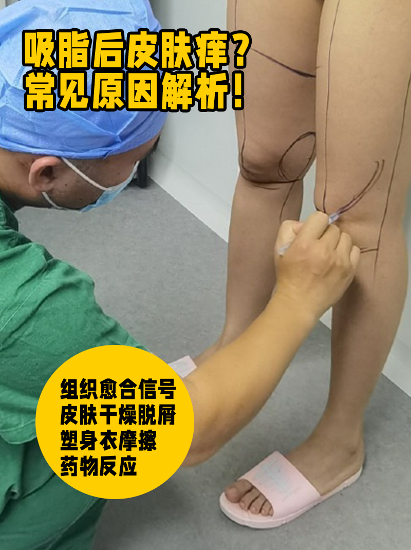 腿部抽脂要多久康复
