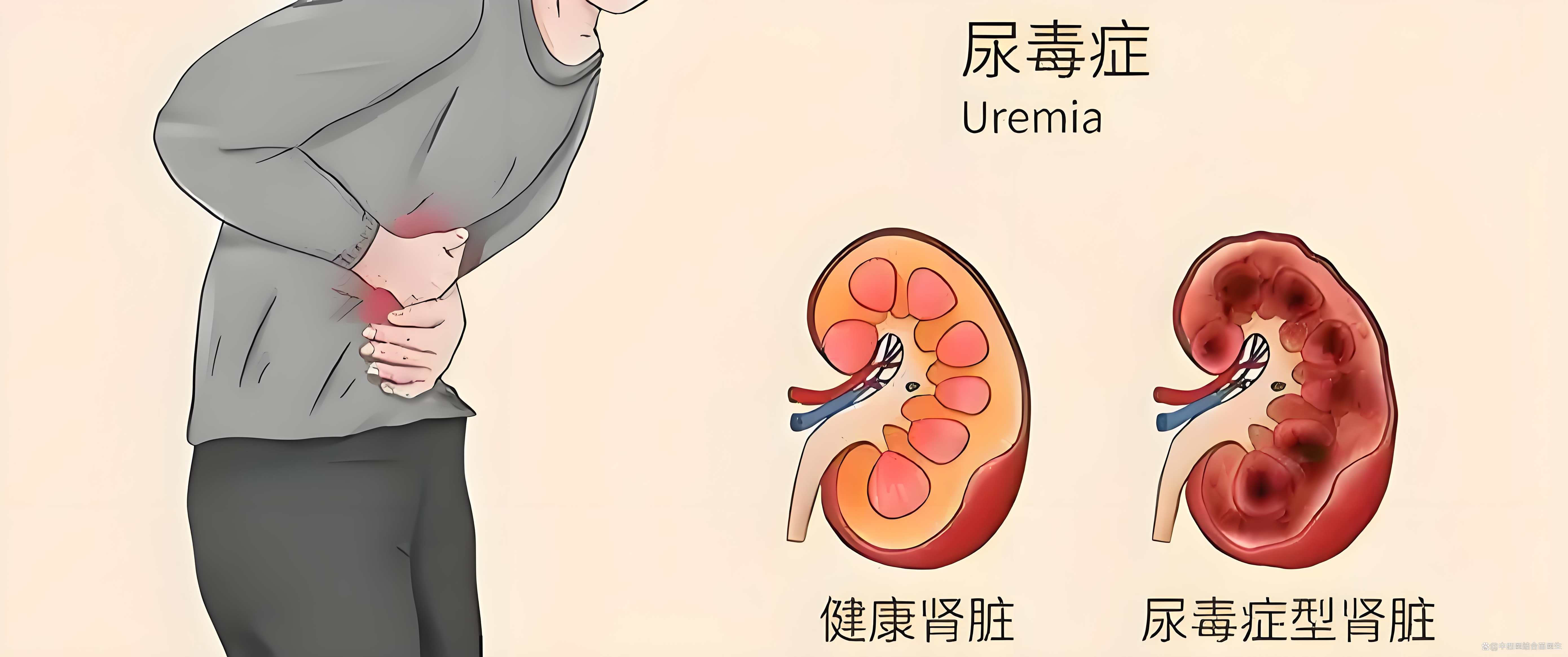 尿毒症早期有什么症状