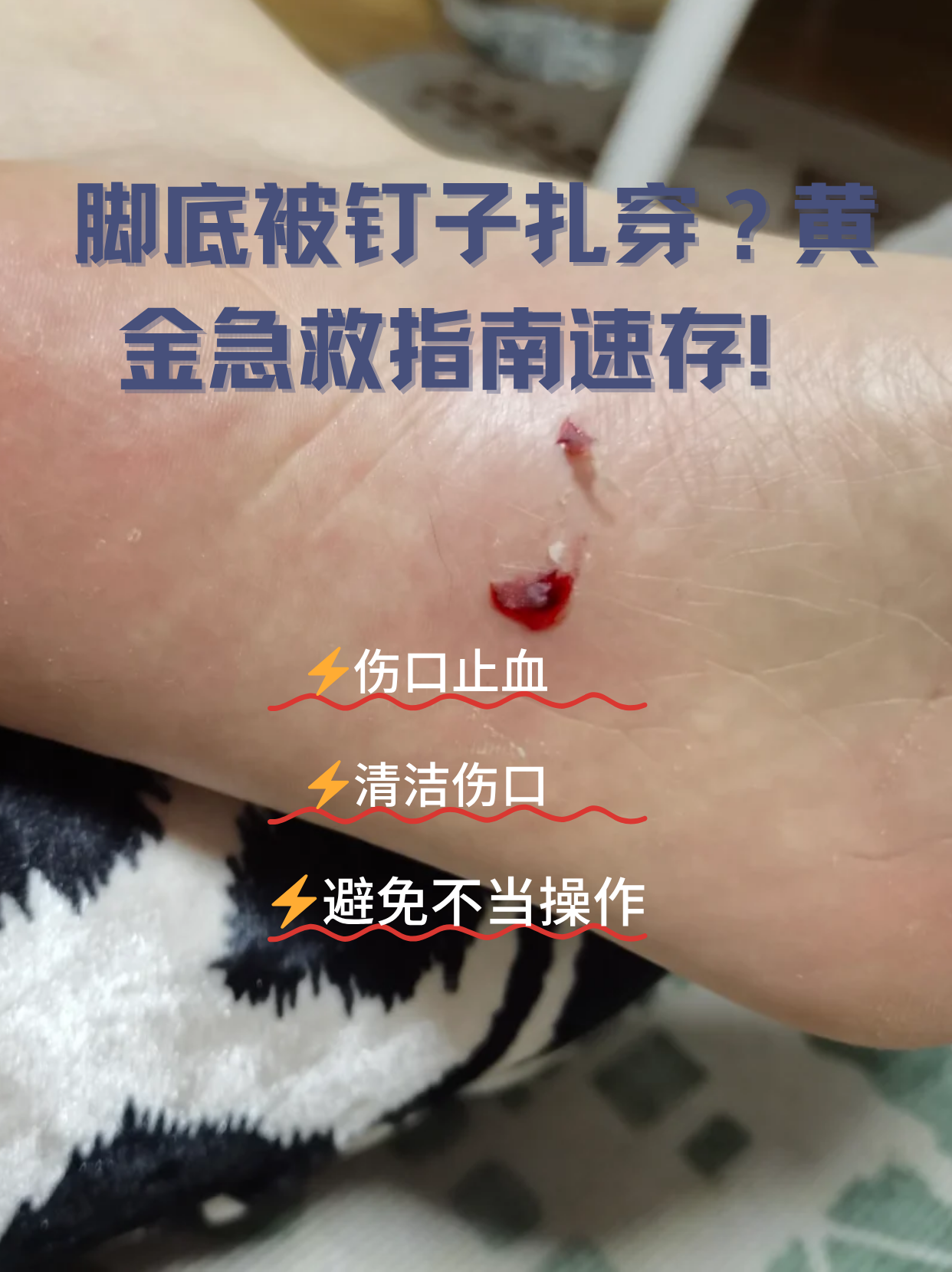 脚扎钉子,没打破伤风