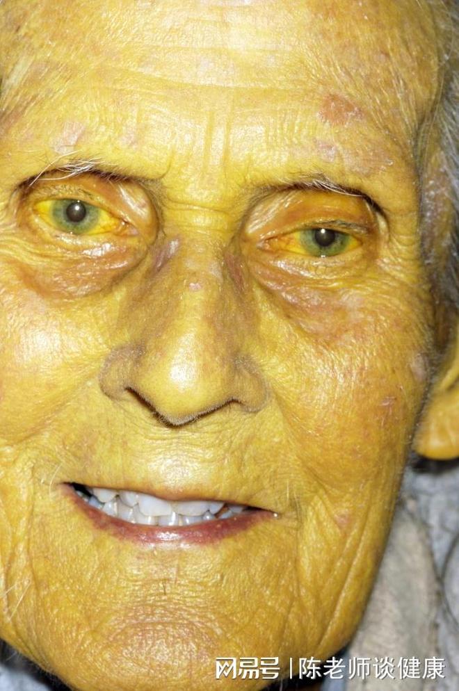 胆囊癌死前一天天征兆