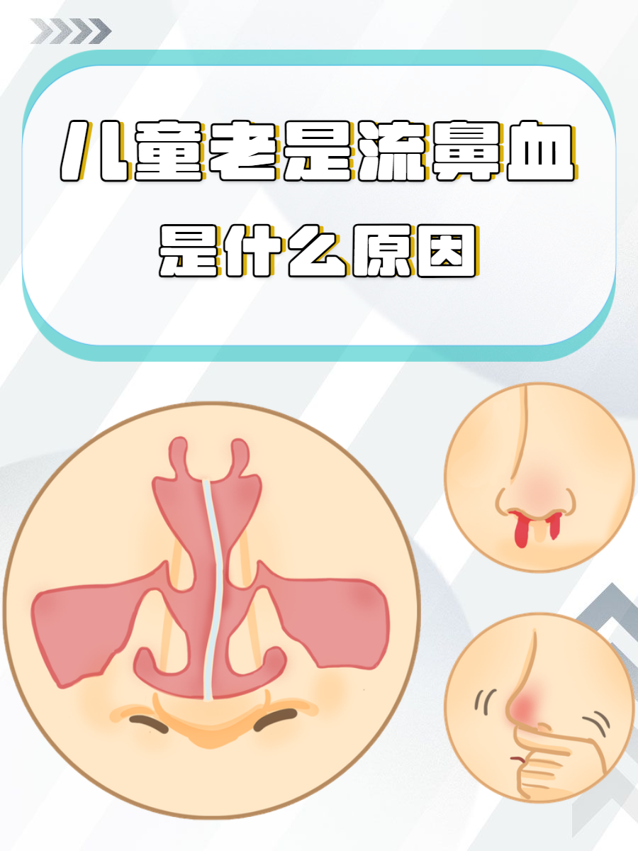 小孩流鼻血是怎么回事?