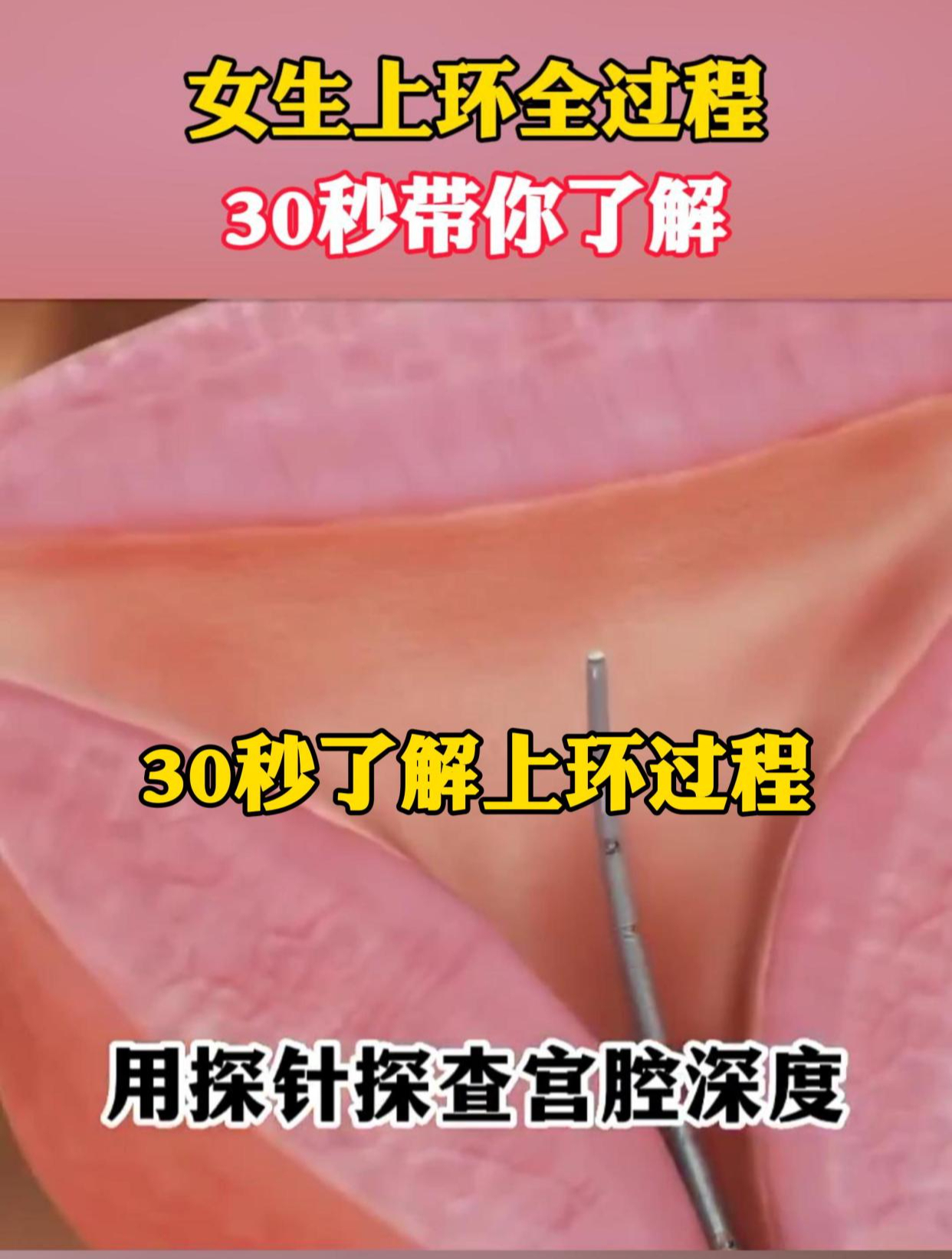 做完人流后多久可以上环