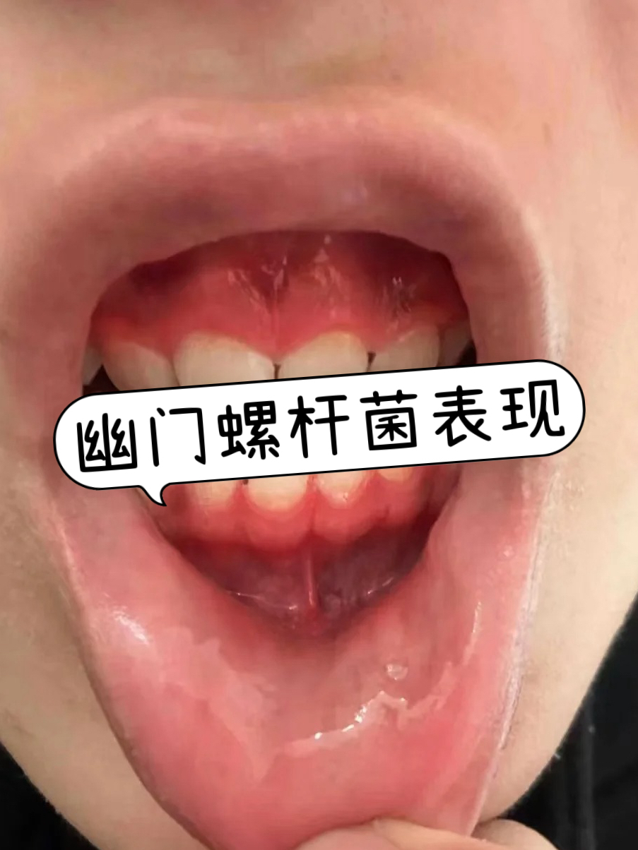 幽门螺旋杆菌感染症状