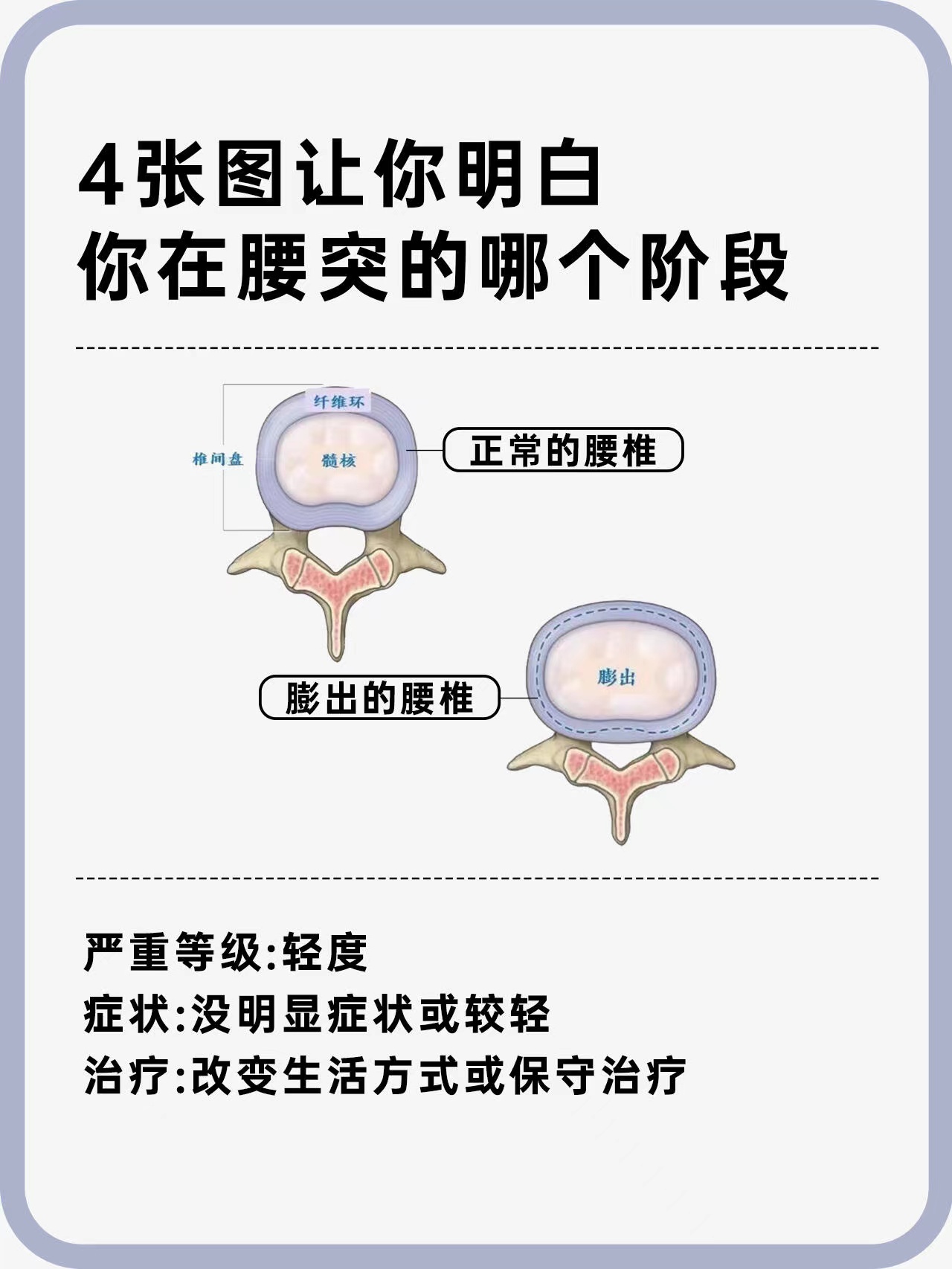 腰椎骨质增生能治好吗