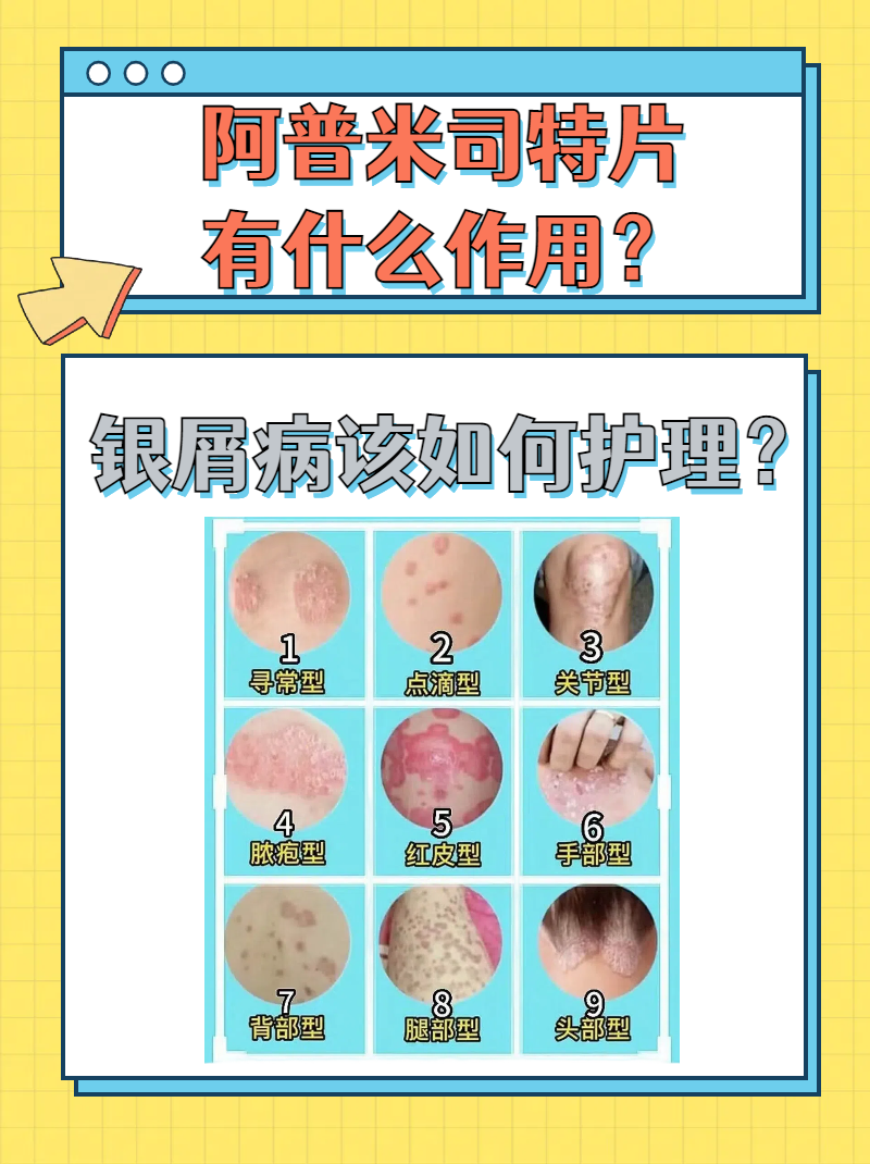 银屑病又快又好的偏方怎么样