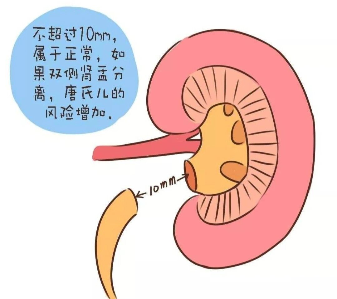 胎儿肾盂分离一定是男孩吗