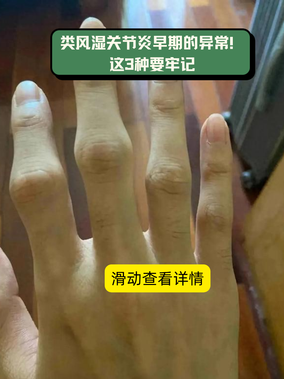类风湿性关节炎的症状是什么?