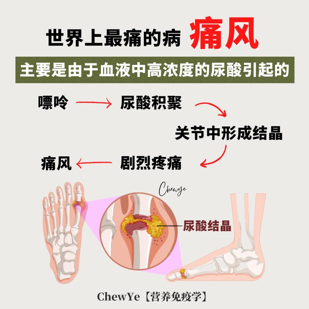 引发痛风的原因