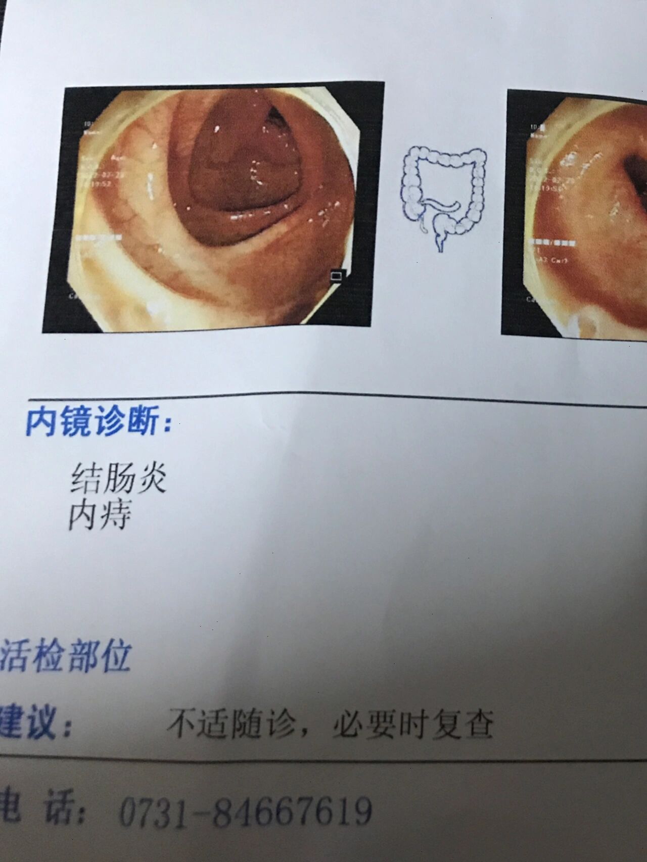 哪些症状需要做肠镜