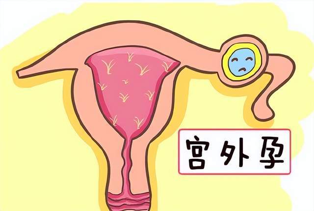 宫外孕有哪些初期症状