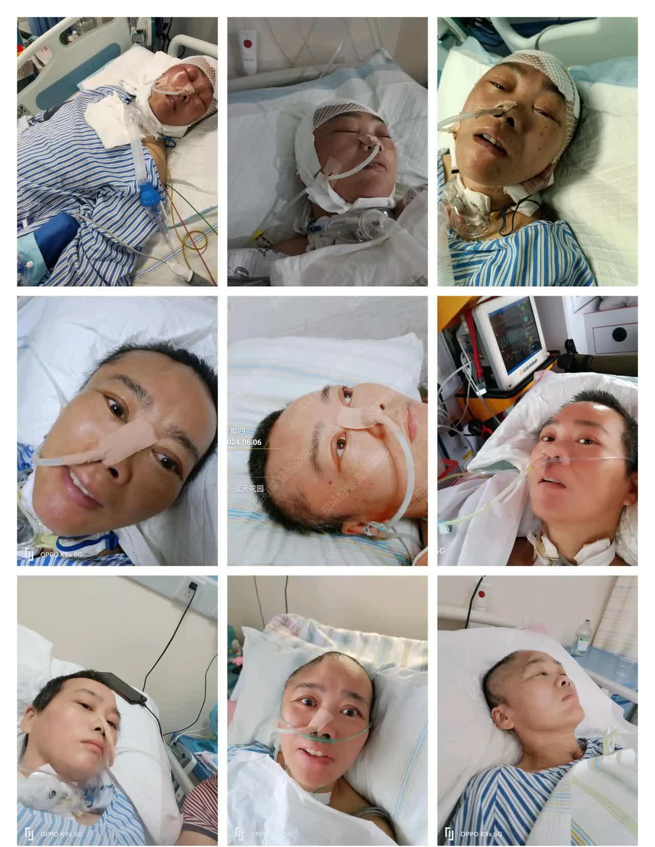 脑出血做开颅手术能活多久